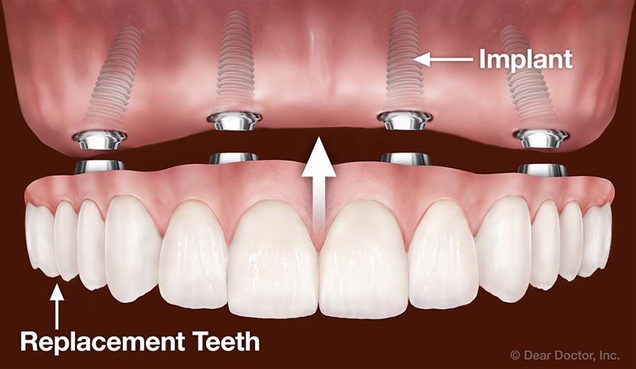 Implant Retained Dentures Wayne NY 14893